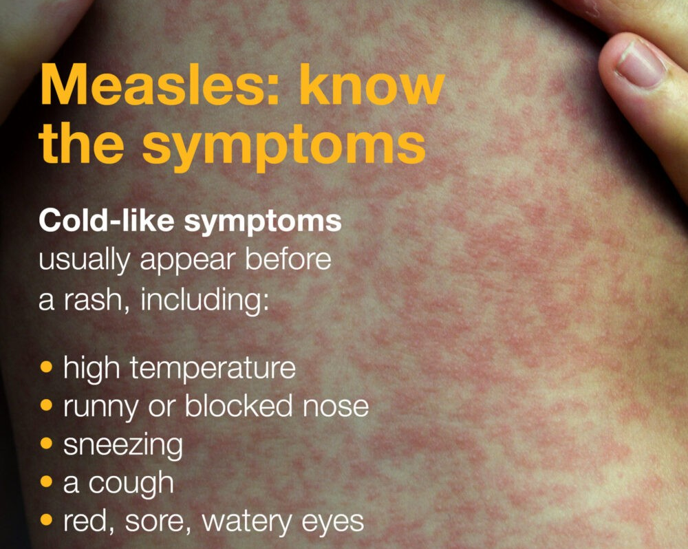 Measles Information for patients, parents and carers